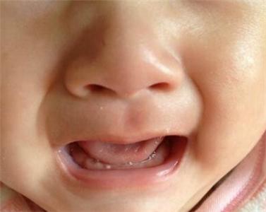 婴儿口腔黏膜白斑 婴儿口腔有点白是怎么回事