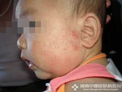 婴儿湿疹最有效的偏方 怎样有效治疗婴儿湿疹