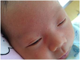 宝宝热痱子症状图片 宝宝长痱子的症状及护理方法