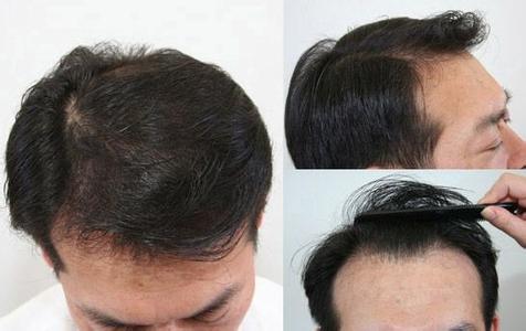 如何治疗脱发的土方法 脱发如何治疗 脱发的治疗方法