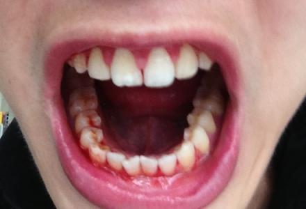 牙龈容易出血是艾滋病 牙龈容易出血怎么办