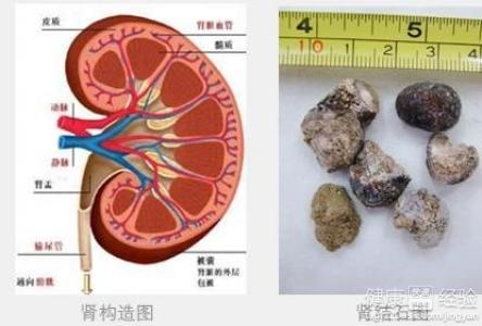 肾结石的形成与治疗 肾结石如何形成的 肾结石的表现和治疗