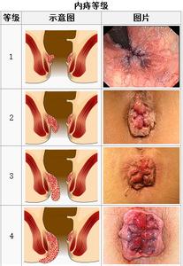 内痔形成的原因 内痔怎么形成的 内痔的形成原因
