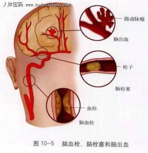 脑血栓形成的临床表现 脑血栓形成的表现 脑血栓形成如何治疗