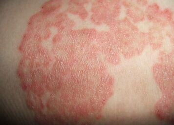 婴儿湿疹形成原因 湿疹形成的根源_湿疹的原因
