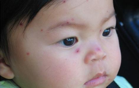 孩子出水痘的症状图片 小孩出水痘有什么症状