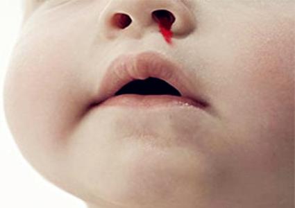 流鼻血是什么病的前兆 鼻子出血是什么原因