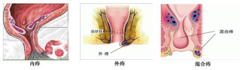 外痔疮如何形成 外痔疮是如何形成的_外痔疮是怎么形成的