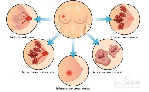 乳腺增生是肿瘤吗 乳腺增生是怎么形成的