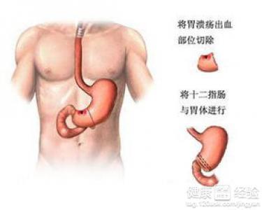 胃窦炎是怎样形成的 胃窦炎的形成原因与治疗