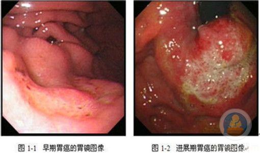 胃癌的治疗方法 胃癌是怎么样形成的 胃癌的治疗方法