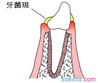 牙结石的形成原因 牙菌斑形成的原因