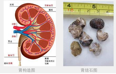 肾结石的形成与治疗 肾结石是怎样形成的 肾结石如何治疗