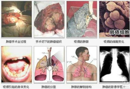 肺癌的早期症状 肺癌是怎样形成的 早期肺癌的症状是怎样的