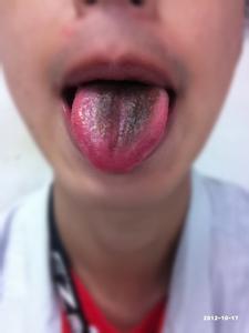 舌苔发黑图片 舌苔发黑是怎么回事