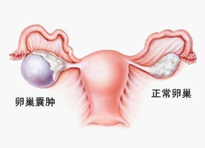 右侧卵巢囊肿怎么引起 卵巢囊肿是什么原因引起的