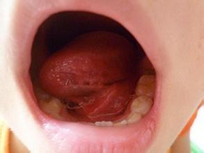 舌下腺囊肿吃什么药 舌下腺囊肿吃什么药_治疗舌下腺囊肿的药