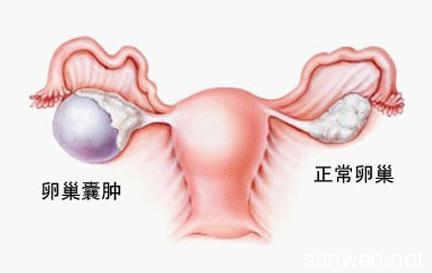 卵巢囊肿形成的原因 卵巢囊肿怎么形成的_卵巢囊肿的原因