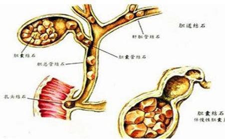 胆总管结石临床表现 胆管结石是怎样形成的 胆管结石有什么表现