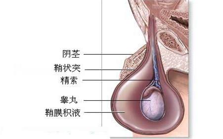 睾丸囊肿有什么危害 睾丸囊肿是怎么形成的 睾丸囊肿有什么危害