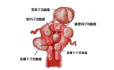 为什么得了子宫肌瘤 子宫肌瘤是怎样形成的