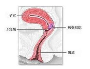 子宫内膜息肉怎样根治 子宫内膜息肉是怎么形成的