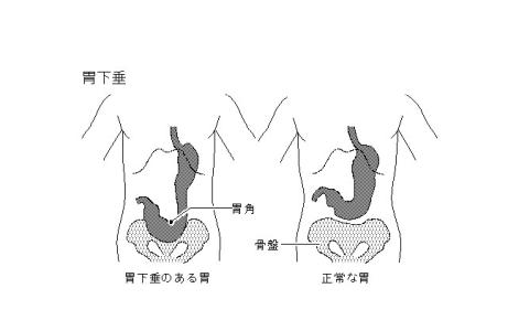 胃下垂是怎么引起的 胃下垂怎么形成的