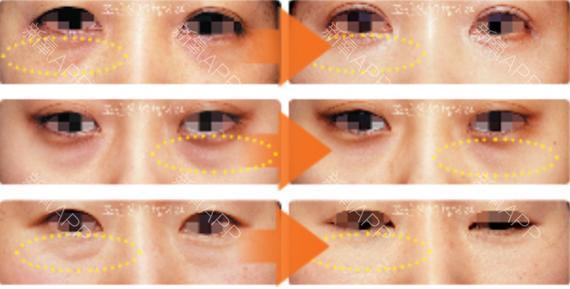 黑眼圈治疗吃什么 吃什么治疗黑眼圈 治疗黑眼圈的食疗方