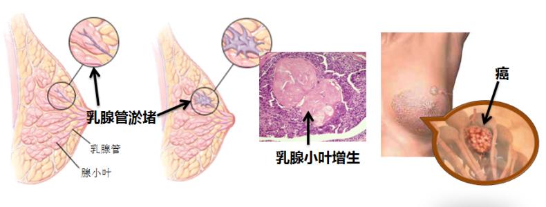 小叶增生的发展过程 小叶增生形成的原因