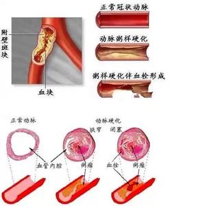 打通心血管堵塞秘方 如何打通堵塞的血管