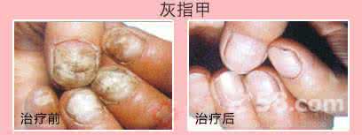 哪些人易感染灰指甲 哪些人易得“灰指甲”？