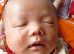 婴儿湿疹症状图片 婴儿湿疹症状表现