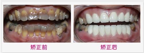 氟斑牙是怎么造成的 氟斑牙形成的原因