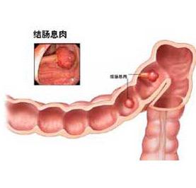 直肠息肉是怎么形成的 肠息肉怎么形成的