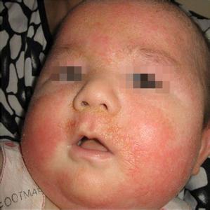 湿疹的常见症状 湿疹的常见类别及其症状