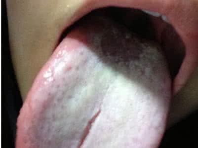 舌苔厚是什么原因 舌苔厚又发白是什么原因