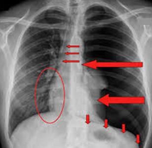 气胸如何治疗 气胸怎么形成的 气胸如何治疗