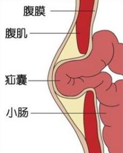 腹壁疝 腹壁疝怎样形成的
