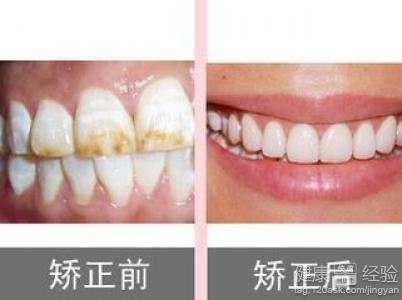 牙齿黄怎么才能变白 黄牙是怎么形成的