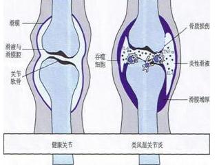 类风湿的形成 风湿类风湿是怎么形成的