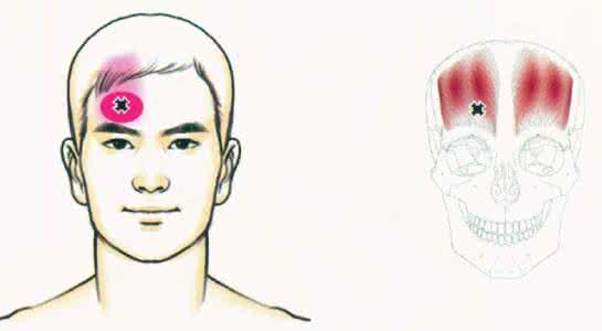 偏头痛怎么治疗 偏头痛怎么形成的 偏头痛的治疗
