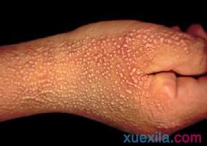 汗斑怎么形成的 汗斑病如何形成的