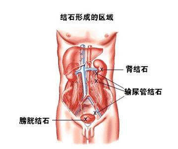 膀胱结石形成的原因 膀胱结石形成的原因 膀胱结石如何治疗