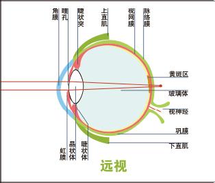 儿童高度远视弱视训练 儿童高度远视加弱视是怎么形成的