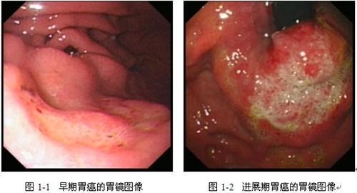 胃癌有什么症状 胃癌是怎么形成的 胃癌有什么症状