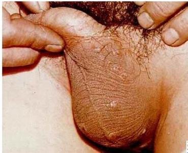 女性阴虱的症状图片 阴虱是怎么形成的