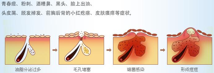 白粉刺是怎么形成的 暗疮是怎么形成的