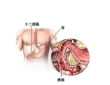 肠溃疡的原因 肠溃疡形成的原因