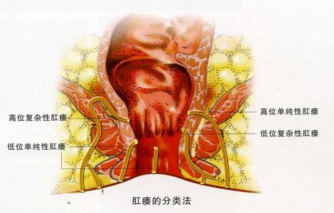 肛瘘是上火形成的吗 肛瘘是如何形成的