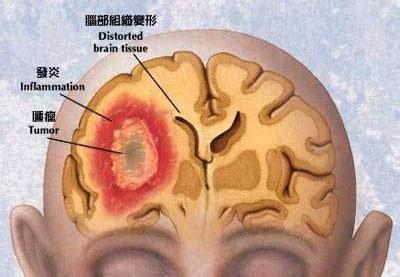 脑瘤手术后能活多久 脑瘤是怎么形成的